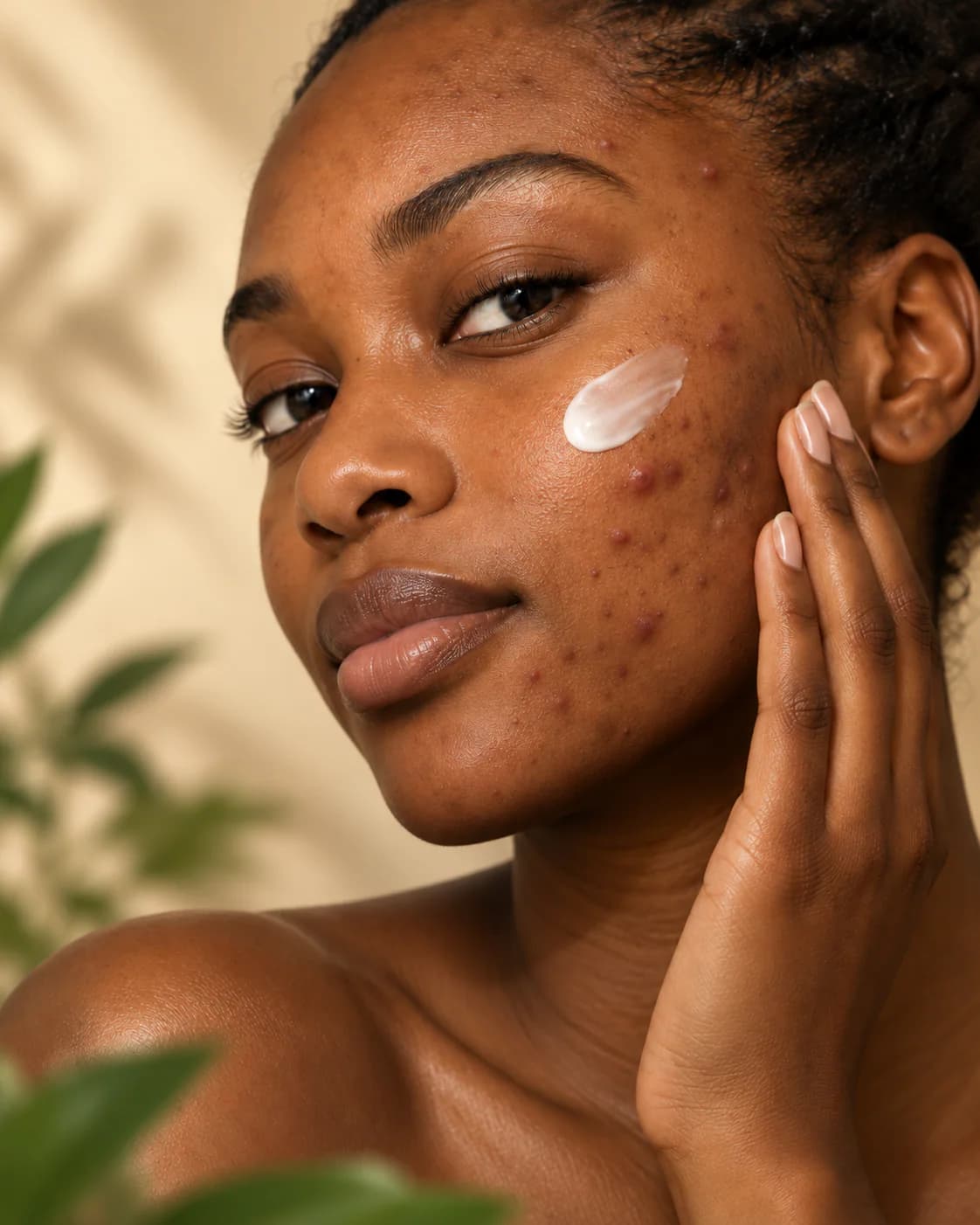 Femme noire présentant des boutons et imperfections visibles sur le visage