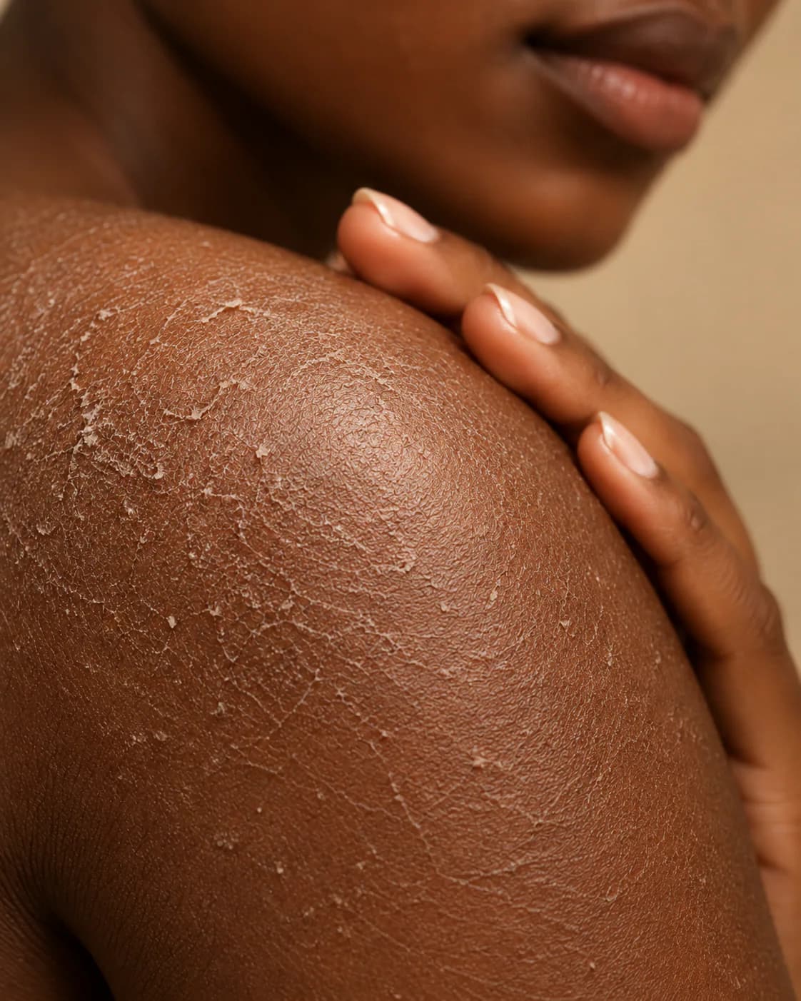 Gros plan sur une peau noire sèche présentant des squames
